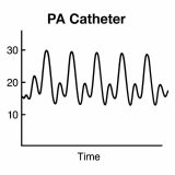 症例検討会　2025年4月 　LMT90%（IABP駆動）　胃癌手術
