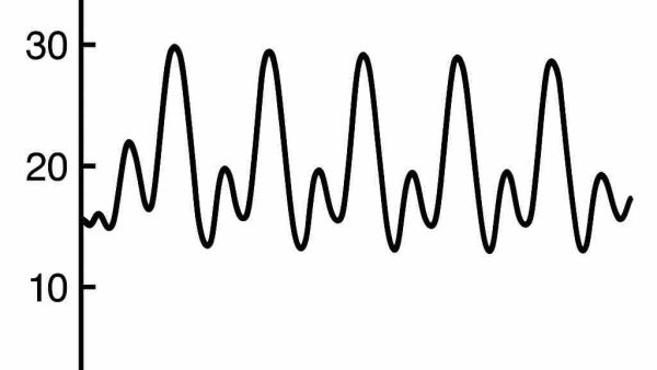 症例検討会　2025年4月 　LMT90%（IABP駆動）　胃癌手術
