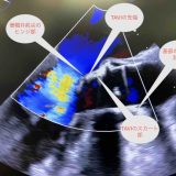 保護中： TAVI初級編3     TEE②  TAVI本番編　ワイヤークロス