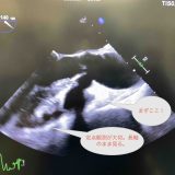 保護中： TAVI 初級編4　　TEE ③   TAVI本番編　デプロイ